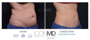 coolsculpting before after abdomen