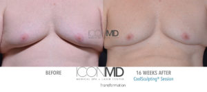 coolsculpting before after chest
