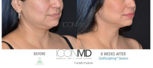 coolsculpting before after neck