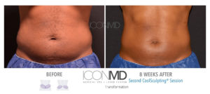 coolsculpting before after abdomen