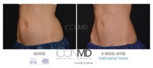 coolsculpting before after abdomen