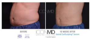 coolsculpting before after abdomen