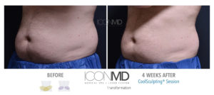 coolsculpting before after abdomen