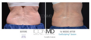 coolsculpting before after back
