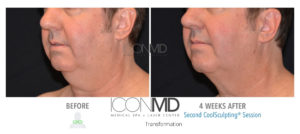 coolsculpting before after neck