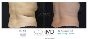 coolsculpting before after back